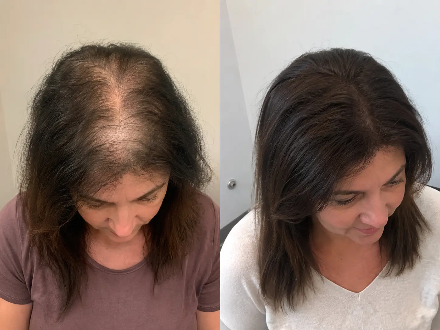 Before — diffuse thinning through the parting and crown, female pattern hair loss
